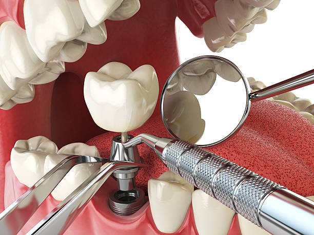 Best Emergency Cosmetic Dentistry (e.g., broken veneers) in Morada, CA